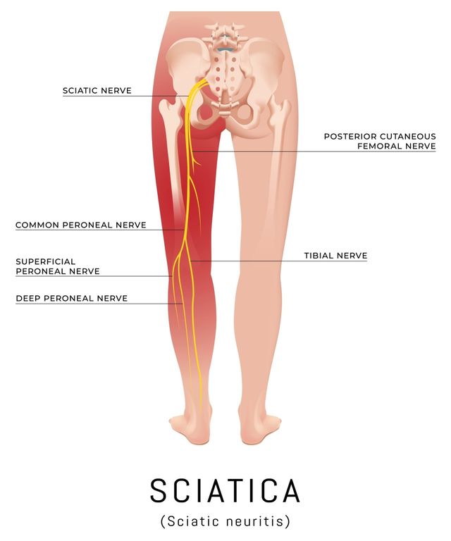 Sciatica Lower Back Pain the Sciatic Nerve